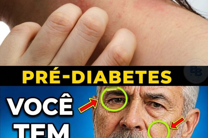 O pré-diabetes é uma condição silenciosa que atinge milhões de pessoas, mas o corpo sempre envia sinais antes do pior acontecer. Você sabia que manchas escuras no pescoço ou pequenas verrugas na pele podem ser um alerta urgente de que seu açúcar no sangue está subindo? Ignorar esses sintomas discretos aumenta drasticamente o risco de infarto e AVC. O diagnóstico precoce é a única forma de reverter o quadro antes que vire diabetes tipo 2. Quer descobrir quais são os 8 sinais que todos os pré-diabéticos têm em comum? Leia o artigo completo no link do primeiro comentário e proteja sua saúde hoje mesmo.