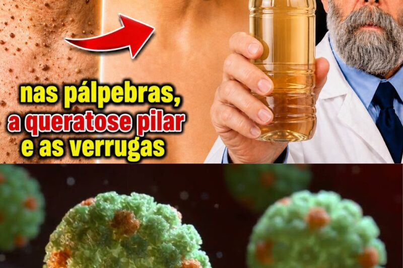 O PODER DO VINAGRE: UMA ABORDAGEM MÉDICA SOBRE A ERRADICAÇÃO DE PAPILOMAS, CONDILOMAS E VERRUGAS GENITAIS