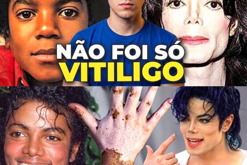 A Anatomia de um Mito: O Dossiê Médico, a Farsa da Mídia e a Verdadeira História por Trás da Pele de Michael Jackson
