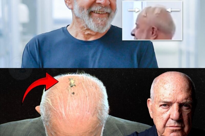 A Verdade Não Contada Sobre a Cirurgia de Lula: Radioterapia, Chapéu e Preocupação Eleitoral