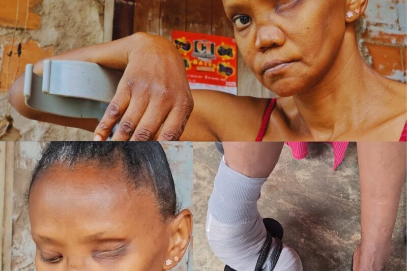 O Abandono Cruel: A Luta de Maria, uma Sobrevivente da Hanseníase que foi Expulsa de Casa pela Própria Família